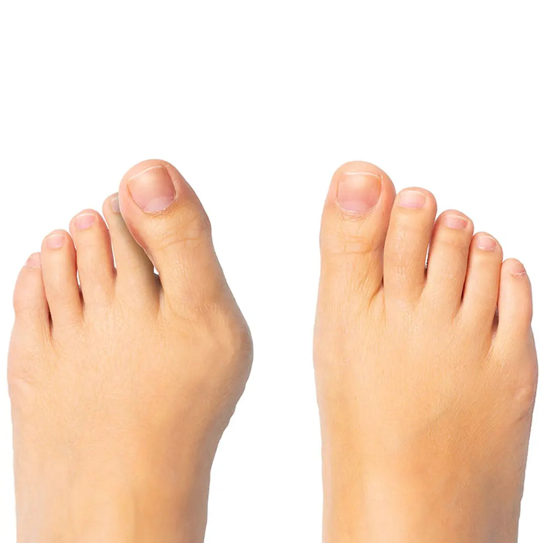 Vergleich Vorher-Nachher: Wirkung der FußGut Zehen-Distanz-Schiene bei Zehenfehlstellungen.