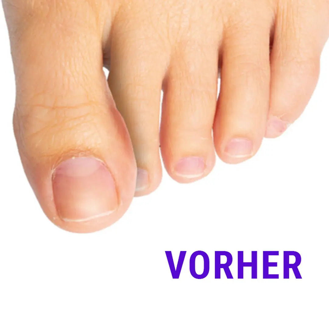 Vorher-Bild mit Zehenfehlstellung ohne Nutzung der FußGut Zehen-Distanz-Schiene.